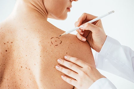 Skin Cancer Screening